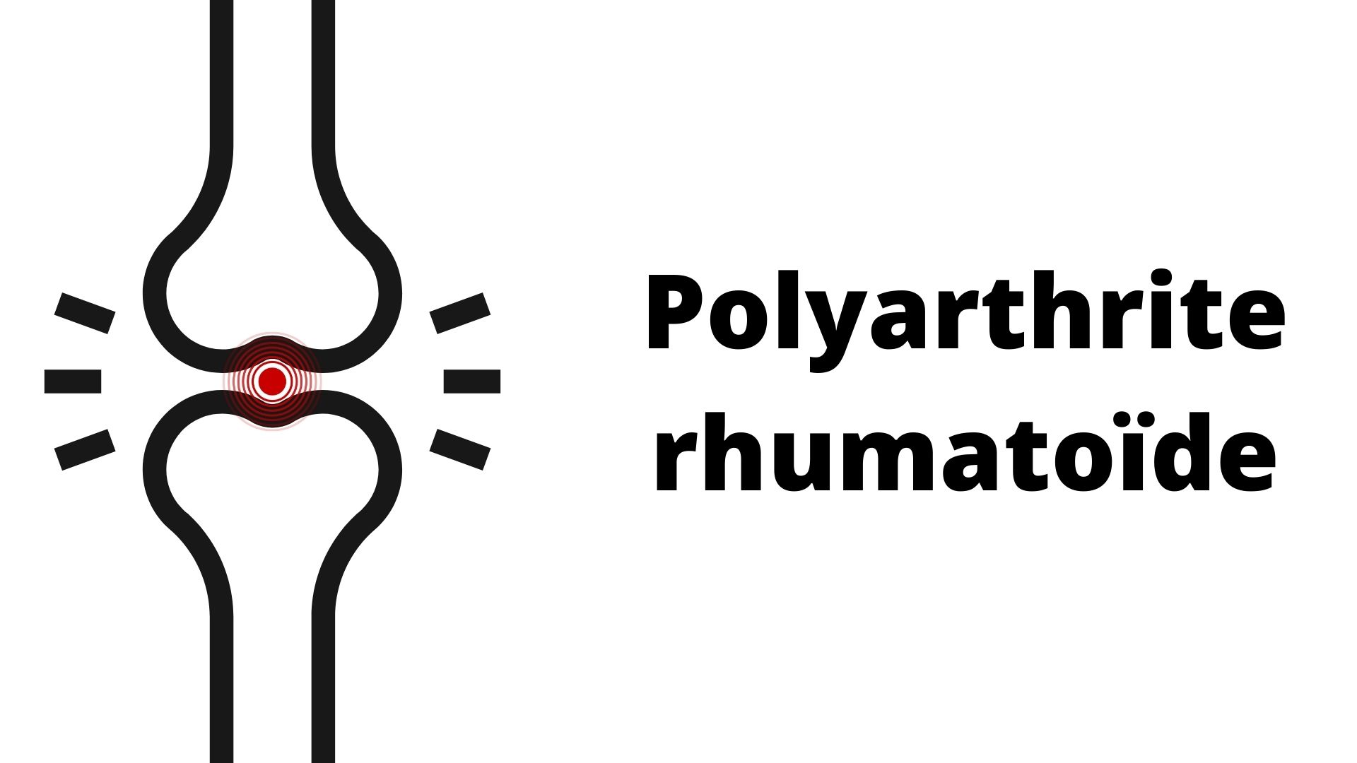 Polyarthrite rhumatoïde : premiers symptômes, causes et traitements